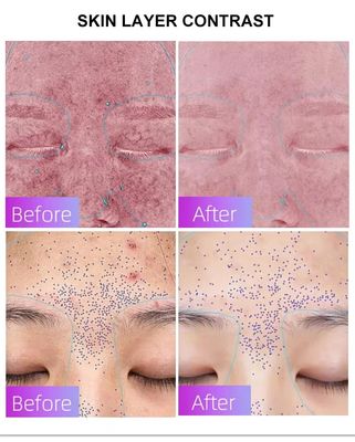 Купить Blue Light Acne Treatment Mask with Intelligent Timer – Manufacturer Direct Supply, Appearance Patent Included онлайн изготовление